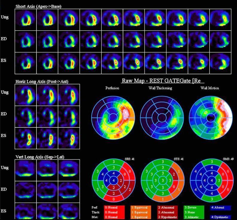 Nukleární medicína Klidový Tc - gated SPECT myokardu