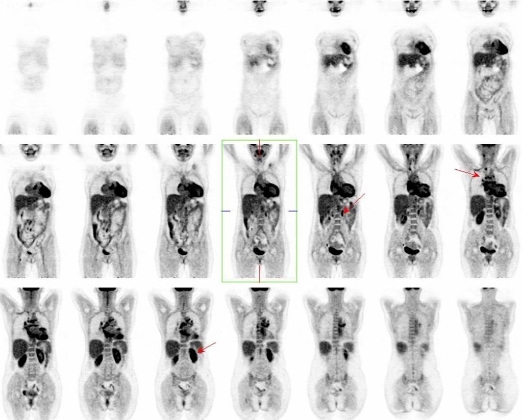 FDG celotělové PET CT Ložiska hypermetabolizmu v srdci, v LU mediastina a retroperitonea a také v obou