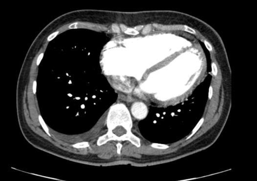 Doplněná vyšetření Ultrazvuk žil: negativní CTAG plic: bez PE, fluidothorax Sono abdomen: normální Gastroskopie: normální Koloskopie: