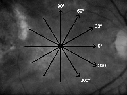 Základním vyšetřením pro oblast makuly na TD OCT je provedení radial lines 6mm řezy po 30 st., jejichž střed je v místě fixačního bodu (obr. 7).