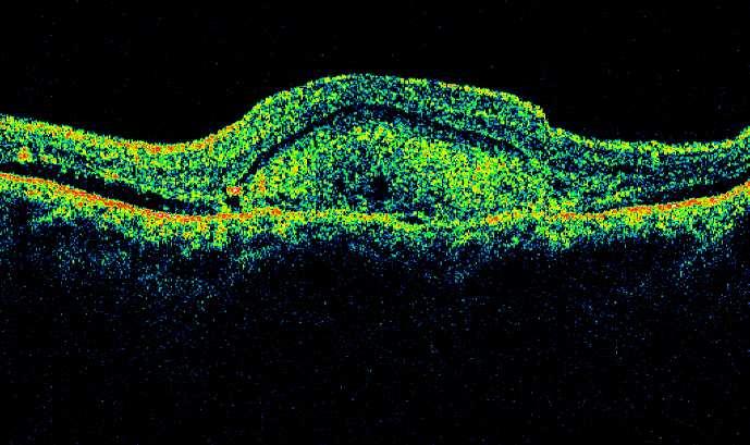 choriokapilaris, z které je RPE retrahován a kde signál proniká do hlubších vrstev. Častá je i drobná serózní ablace neuroretiny.