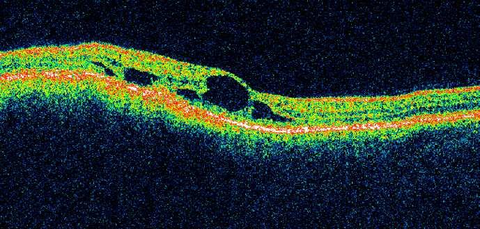 přítomností fluoresceinu mimo cévní lumen. Charakteristický pro melanom cévnatky je obraz dvojité cirkulace, která je výsledkem současné fluorescence retinálních a choroidálních cév.