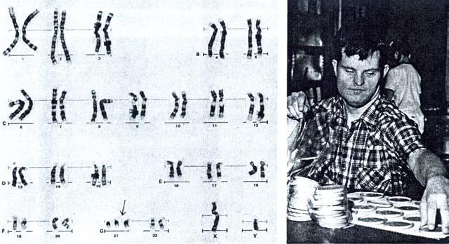 a) karyotyp, b) jedinec (podľa Russella, 1998) Pri rastlinách sa aneuploidia využíva v chromozómovom inžinierstve.