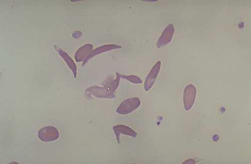 Přírodní výběr příklad selekce ve prospěch heterozygotů srpkovitá anemie AA - normální hemoglobin SS - srpkovitá anemie AS - jen slabé postižení v normálním prostředí probíhá selekce proti alele S