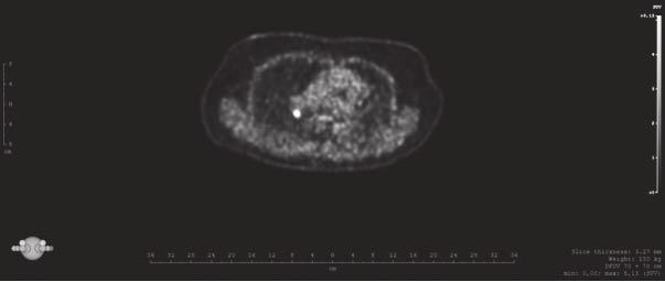 VZÁCNÁ PŘÍČINA SEKUNDÁRNÍHO CUSHINGOVA SYNDROMU Cushing Harvey Williams (1869 1939) americký neurochirurg.