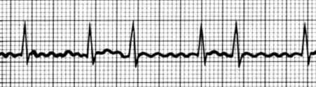 diagnostika FS Fibrilace síní EKG nepřítomnost vlny P, fibrilační vlnky, nepravidelná komorová akce