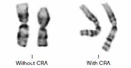 ProCell GGS JL003 Chromosome Resolution Additive (CRA) Chromosome Resolution Additive Výrazně zvyšuje rozlišení pruhů na chromozomech Antagonista colchicinu redukuje zkracování chromozomů Velmi