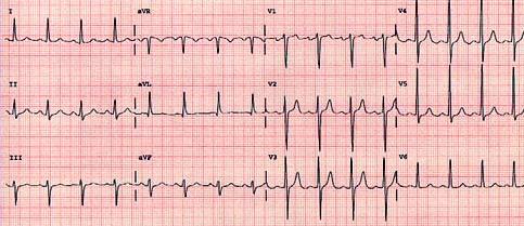 8. Bolest mezi lopatkami a v zádech (aneurysma aorty) Pacient PCH, 60 let 1.