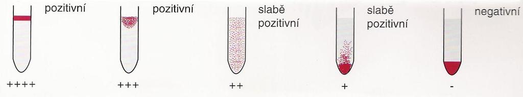 Obr. 5 Sloupcová aglutinace síla pozitivity podle velikosti komplexu antigenprotilátka [22] Orientační určení protilátky provádíme pomocí přiloţené tabulky u dg. erytrocytů.