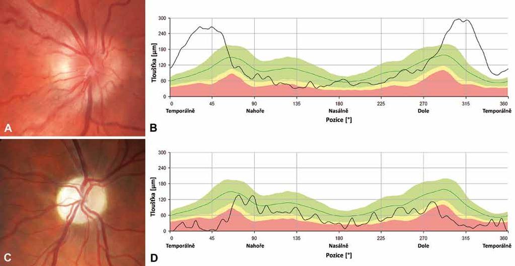 Obr. 3. Nálezy na terčích zrakového nervu u dvou pacientů s LHON. Barevná fotografie papily zrakového nervu pravého oka 20letého muže s m.