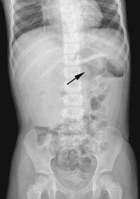 Diagnostika pokročilejší stav se známkami obstrukce nativ břicha vstoje / ve visu - příznak půlměsíce dříve