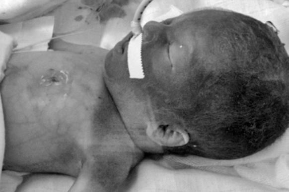 VYŠETŘENÍ A MONITOROVÁNÍ NOVOROZENCE PO PORODU Obr. 4.2: Novorozenec po těžké perinatální asfyxii s mnohočetnými traumaty. Stav po kardiopulmonální resuscitaci (viz hematom v dolní třetině sterna).