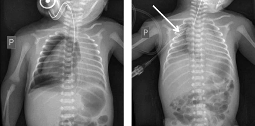 KOMPLIKACE PŘI RESUSCITACI Terapie pneumothoraxu drenáž hemithoraxu při resuscitaci Adekvátní výběr drénu (8F, 10F). Analgosedace se rutinně při resuscitaci na porodním sále neprovádí.