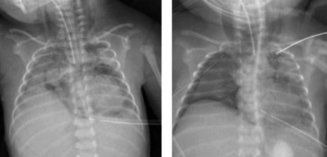 KOMPLIKACE PŘI RESUSCITACI Obr. 9.2: Těžký air-ieak syndrome: pneumoperikard, bilaterální pneumothorax se zavedeným drénem vlevo, pneumomediastinum. 9.2 Pneumoperikard Přítomnost vzduchu v perikardiálním prostoru, který může způsobit fatální perikardiální tamponádu.