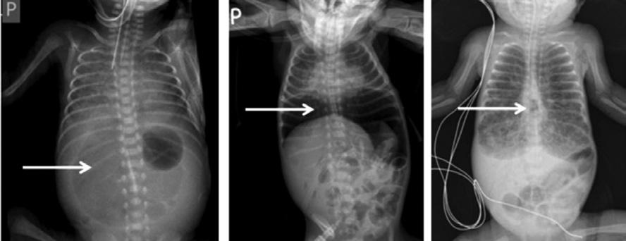 KOMPLIKACE PŘI RESUSCITACI Obr. 9.3: Pneumoperitoneum a vzduchová embolizace (kolekce vzduchu viz šipka).