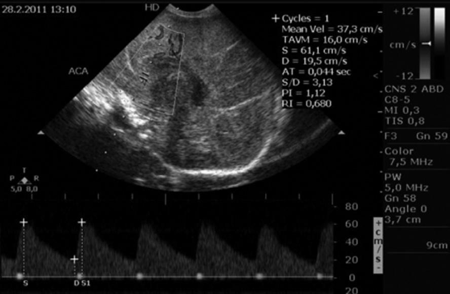 PERINATÁLNÍ ASFYXIE POST-RESUSCITAČNÍ PÉČE Latentní fáze (doba trvání 6 15 hodin) Mozková cirkulace a oxygenace se po resuscitaci stabilizuje, buněčný energetický metabolismus se obnovuje.