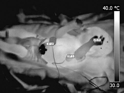 STABILIZACE A RESUSCITACE NOVOROZENCE EXTRÉMNĚ NÍZKÉ PORODNÍ HMOTNOSTI Nastavení průtoku: Dostatečný průtok k zajištění umělé plicní ventilace a přítomnosti krátké fáze plató je 6 8 l/min). Obr. 15.