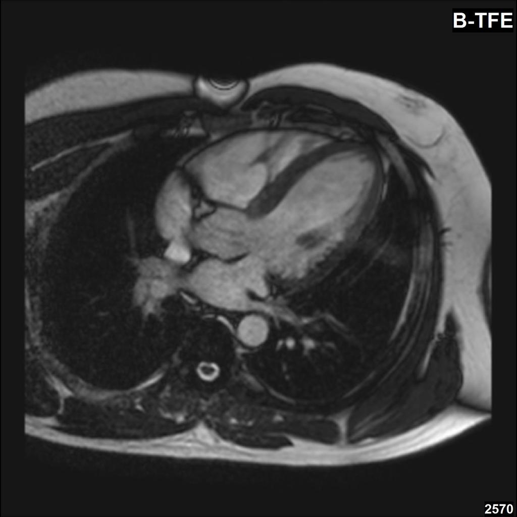 MR srdce / MRI of the heart transverzální řez / transverse section ventriculus dx. sinus aorticus dx. trabecula septomarginalis septum interventriculare ventriculus sin.