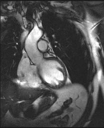 MR srdce: výtoková část levé komory MRI of the heart: pars/tractus effluxionalis ventriculi sinistri (aortic