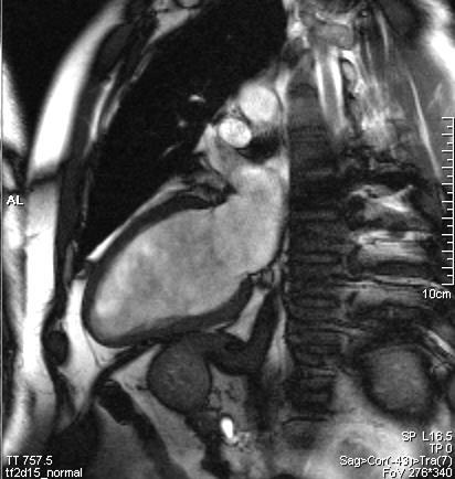 MR srdce: 2komorová projekce dlouhá osa MRI of the heart: 2-chamber vertical long axis ventriculus sinister (paries