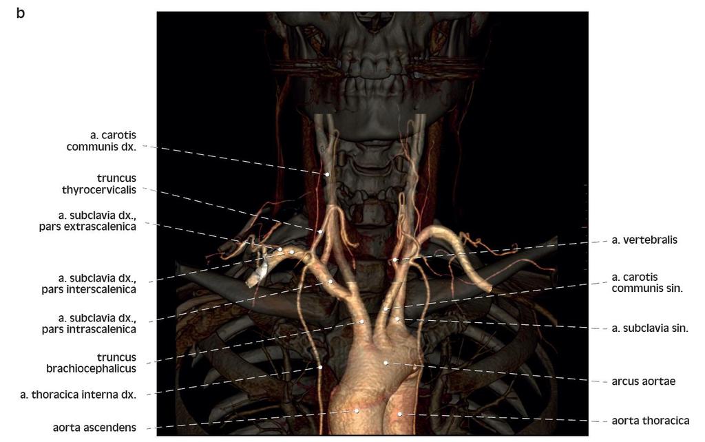 3D rekonstrukce CT angiografie srdečnice 3D