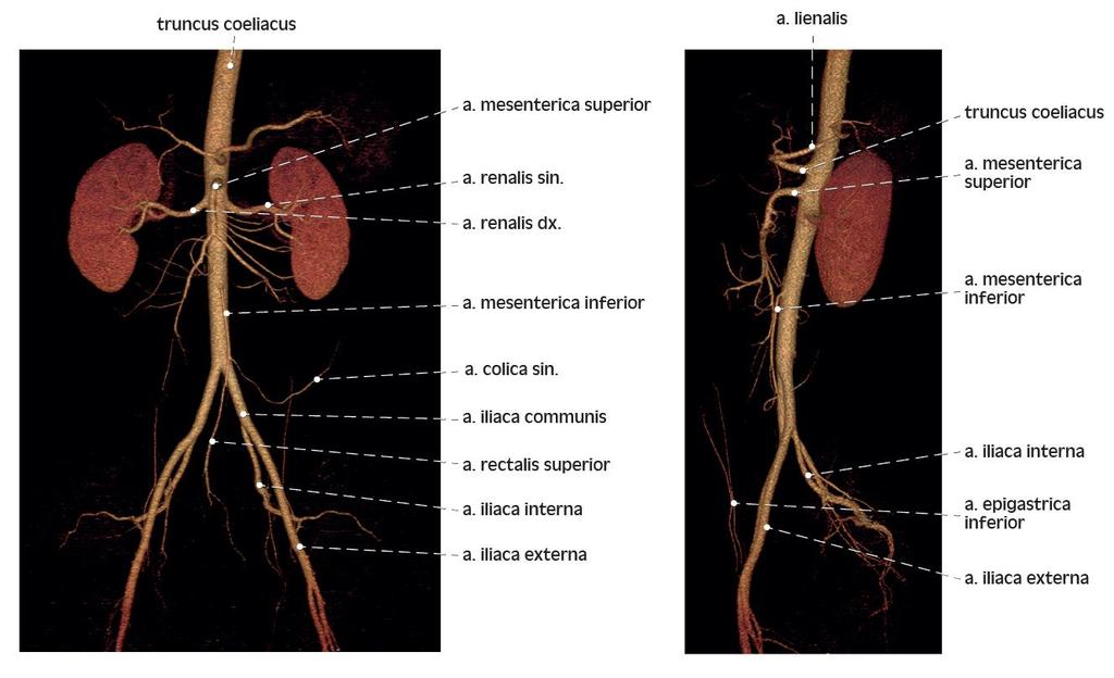 3D rekonstrukce CT angiografie břišní srdečnice 3D