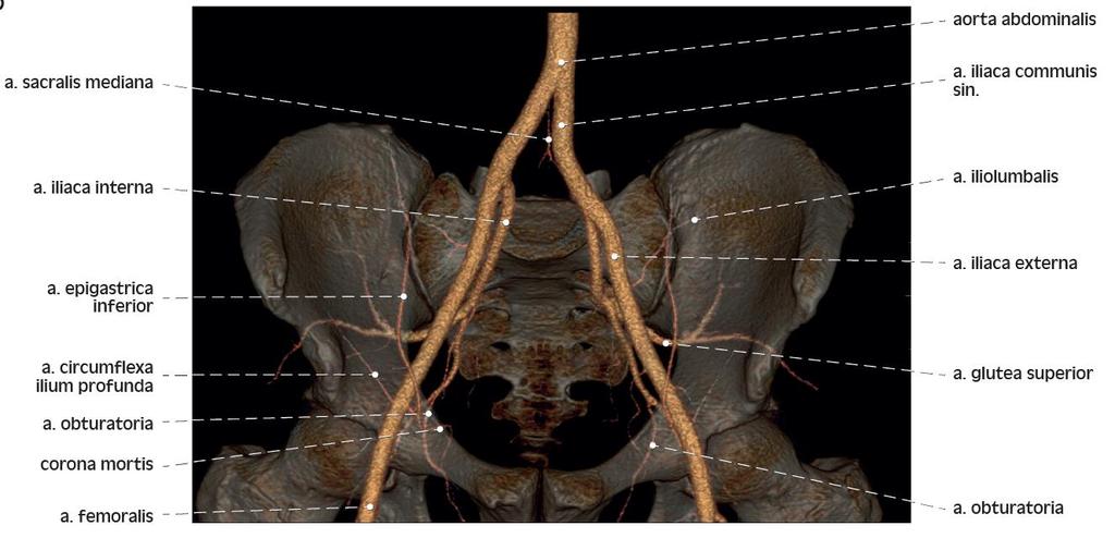 3D rekonstrukce CT angiografie pánevních tepen 3D reconstruction of CT