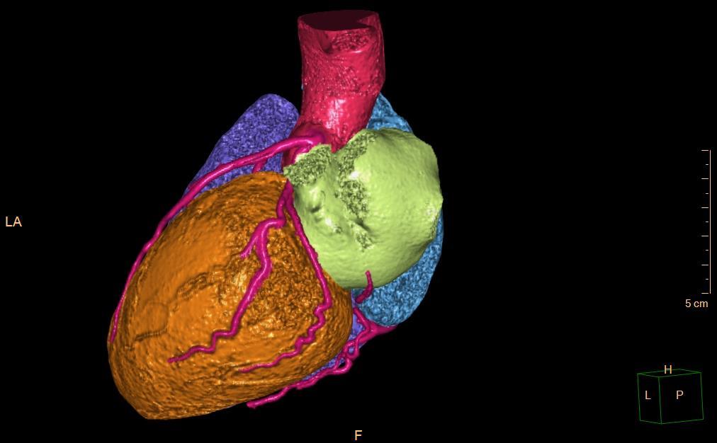 3D CT koronarografie / 3D CT coronarography pohled zleva / left view a. coronaria sin. ventriculus dx. r.