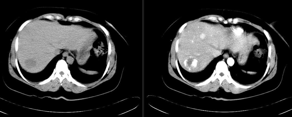 HEMANGIOM CT: Nativně hypodenzní (ne v terénu difuzní léze), postkontrastně se sytí z periferie v art.