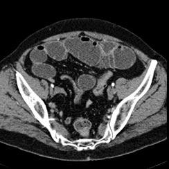 Small bowel obstruction caused by fibrous adhesions developed after appendicectomy Images show transient zone in the ileum with distension of proximal loops.