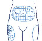 Výběr místa vpichu Možná místa v podkoží břicha, paží, stehen a hýždí Různá místa = různá rychlost vstřebání : 1/ břicho 2/ramena