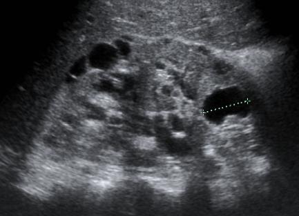 insuficience fibrosa jater, nepřímá úměra k postižení ledvin
