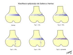 Klasifikace otevřených zlomenin Gustillo - Tscherne 1. stupeň měkké tkáně včetně kůže jsou probodeny ostrým kostním úlomkem zvnitřku ven. Rána je menší než 5 cm. 2.
