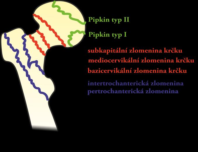 Zlomeniny proximálního femuru Obrázek 9 Typy zlomenin proximálního femuru (42) Zlomeniny krčku femuru (intrakapsulární) K těmto zlomeninám dochází přímým mechanismem (při pádech na bok), ale