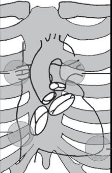 Anatomická lokalizace poslechových míst aortální chlopeň