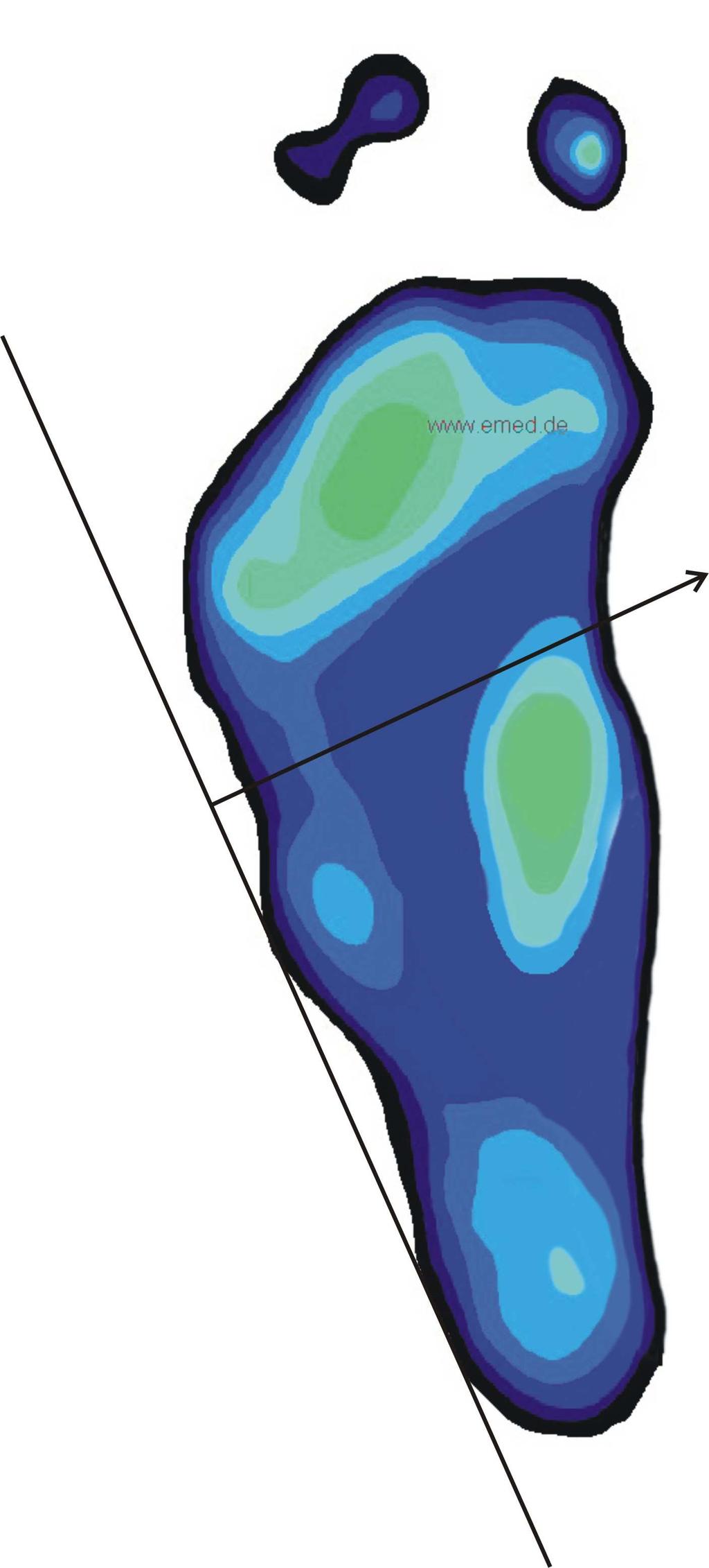 Plochá noha je tedy obecný termín označující výrazné snížení nožní klenby nebo její úplné vymizení. Obecně je také důležité zdůraznit rozlišení vrozené a získané ploché nohy. Např.
