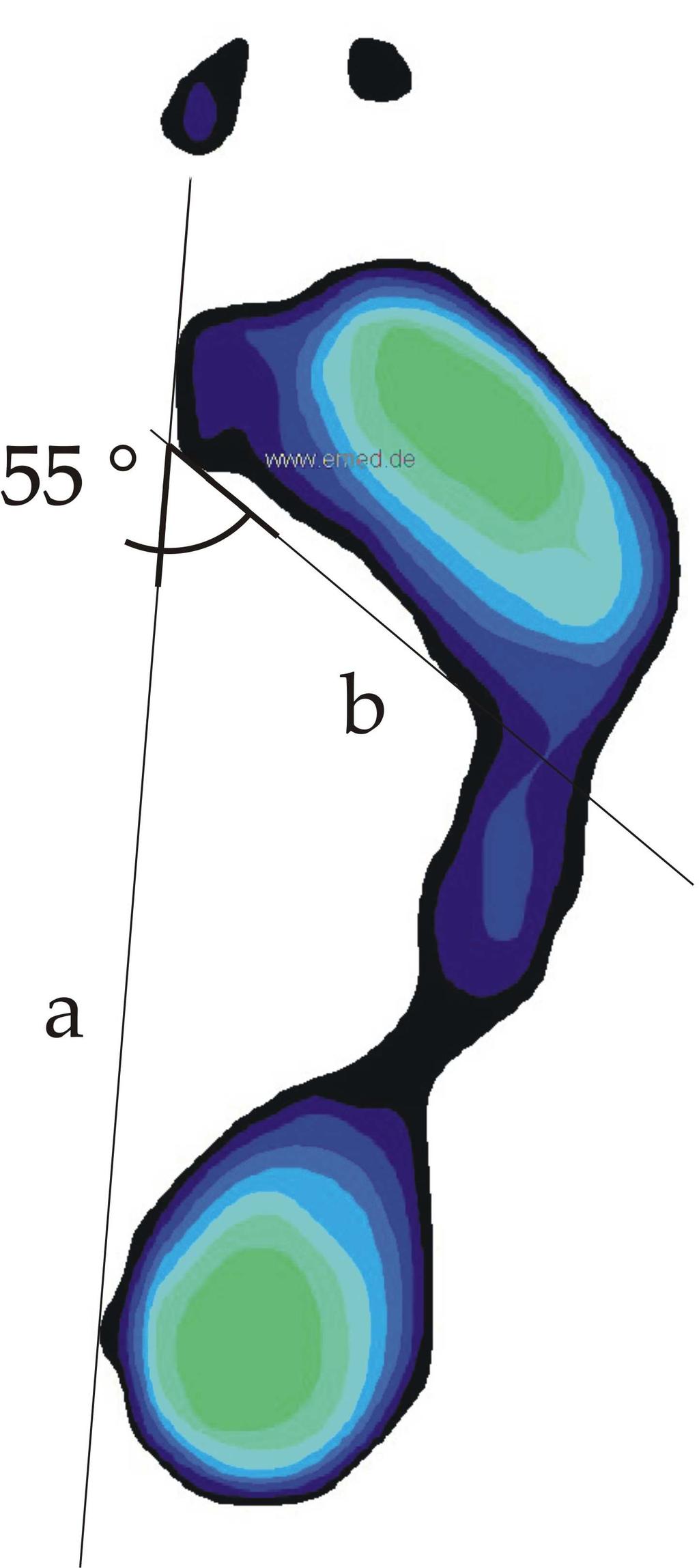 prostudovat obrázek, kde je noha zobrazená na plantogramu definována jako normální (viz obr. 19). Škála pro normální nohu je od 45 do 55 [19]. Obr.