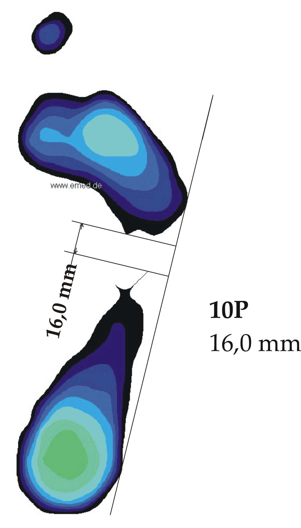 Naměřené hodnoty vysokých nohou se u jednotlivých probandů, na rozdíl od probandů s normálně kletou nohou, velice liší (viz tab. 6). Některé rozměry se liší i o několik centimetrů.