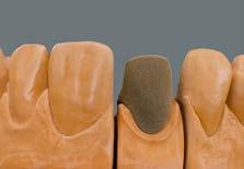 Nanášení opakeru u keramického gingiválního okraje korunky Nanášení WASH brand se provádí podobně jako u můstku.