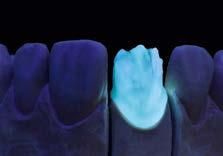 Individualizující vrstvení na příkladu korunky pro jednotlivý zub Kapnička vypálená s hmotou LUMINARY...... osvětlená ultrafialovým světlem.
