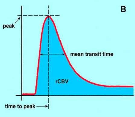 Perfúzní zobrazení Funkční metoda denzita tkáně závisí lineárně na obsahu jodu z křivky sycení během prvního oběhu lze vypočítat perfúzní parametry -malé mn.
