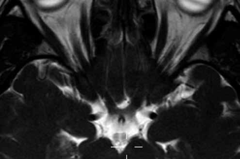 Důležitou roli v diagnostickém algoritmu zastává i CT (výpočetní tomografie) vyšetření, které je oporou zejména v diagnostice kalcifikací v měkkých tkáních očnice, ale i kostních strukturálních změn