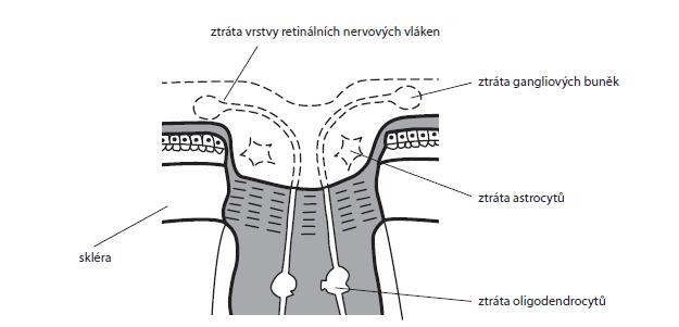 12 Anatomie a fyziologie oka 1.6.1. Poškození terče zrakového nervu Pří zvýšení nitroočního tlaku může nastat i přímé poškození lamina cribrosa.