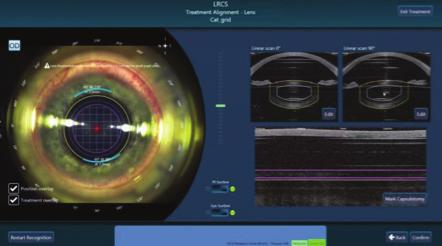 Informační bulletin společnosti SPIRTI MEDICAL Strana 5 Nová generace femtosekundového laseru VICTUS Společnost Bausch+Lomb/Technolas (Něměcko) zahájila distribuci třetí generace femtosekundového