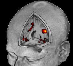 Funkční zobrazování magnetickou rezonancí fmri = functional magnetic resonance imagin, je moderní zobrazovací metoda, pomocí níž se snažíme mapovat funkční oblasti mozku aktivované při provádění