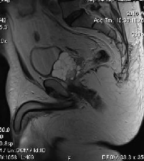 75 Obr. 1 MRI sagitální řez cystický nádor prostaty Fig. 1 MRI sagittal plane cystic tumor of prostate Obr. 2 MRI koronární řez cystický nádor prostaty Fig.