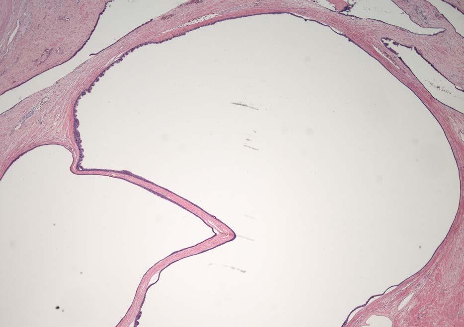 76 Obr. 3 Histologický nález většiny cyst zvětšeno 20x Fig.