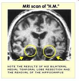 Kognitivní neuropsychologie Pacient H.M.