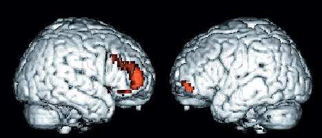 postižená selektivně paměť pro jména a fakta Oddělené aktivitou mozku vybavení epizodické vzpomínky aktivuje