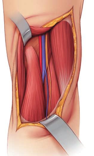 4 Retrahujte m. semimembranosus Najděte m. semimembranosus a mediálně ho retrahujte. Odhalí se úpon mediální hlavy m. gastrocnemius. 5 Odhalte struktury Najděte přední okraj m.